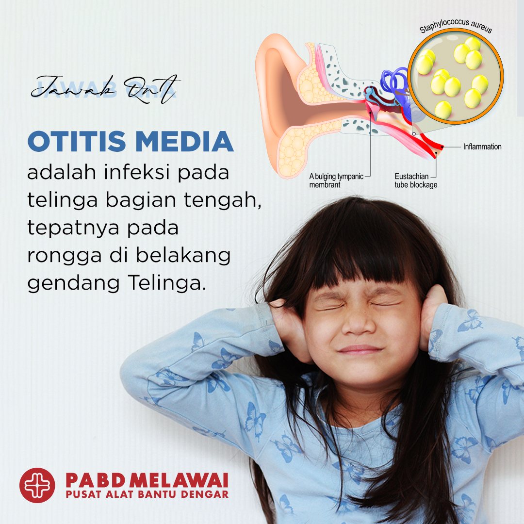 Jawab QnA Otitis Media