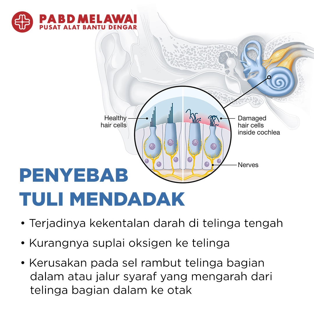 Penyebab Tuli Mendadak